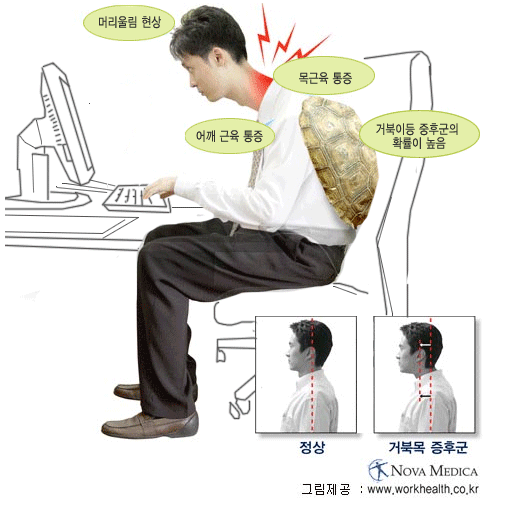 거북 목 증후군
																															 1.머리울림 현상
																															 2.목근육 통증
																															 3.어깨 근육 통증
																															 4.거북이등 증후군의 확률이 높음