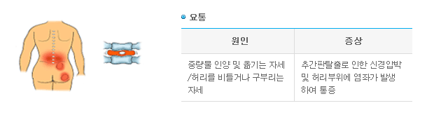 요통 -> 1.원인-중량물 인양 및 옮기는 자세/허리를 비틀거나 구부리는 자세 2.증상-추간판탈출로 인한 신경압박 및 허리부위에 염좌가 발생하여 통증