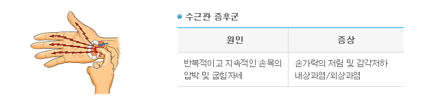 수근관 증후군 -> 1.원인-반복적이고 지속적인 손목의 압박 및 굽힘 자세 2.증상-손가락의 저림 및 감각저하 내상과염/외상과염