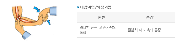 내상과염/외상과염 -> 1.원인-과다한 손목 및 손가락의 동작 2.증상-팔꿈치 내 외측의 통증