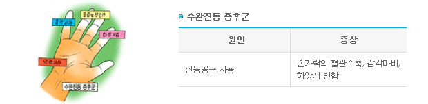 수완진동 증후군 -> 1.원인-진동공구 사용 2.증상-손가락의 혈관수축, 감각마비, 하얗게 변함