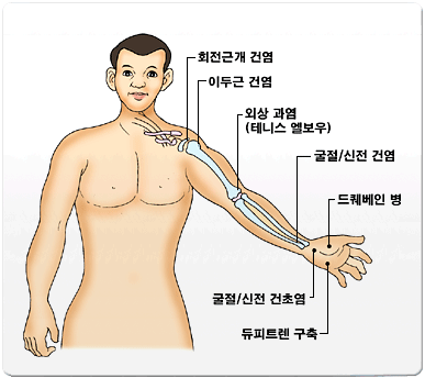 회전근개 건염, 이두근 건염, 외상과염(테니스 엘보우), 굴절/신전 건염, 드퀘베인 병, 굴절/신전 건초염, 듀피트렌 구축 그림