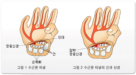 그림1 수근관 터널 그림2 수근고나 터널의 건과 신경