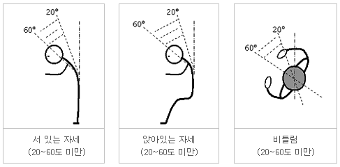 보통 구부려지거나 비틀림이 있거나 굽혀져 있는 자세