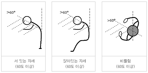 극단적으로 구부려지거나 비틀림이 있거나 굽혀져 있는 자세